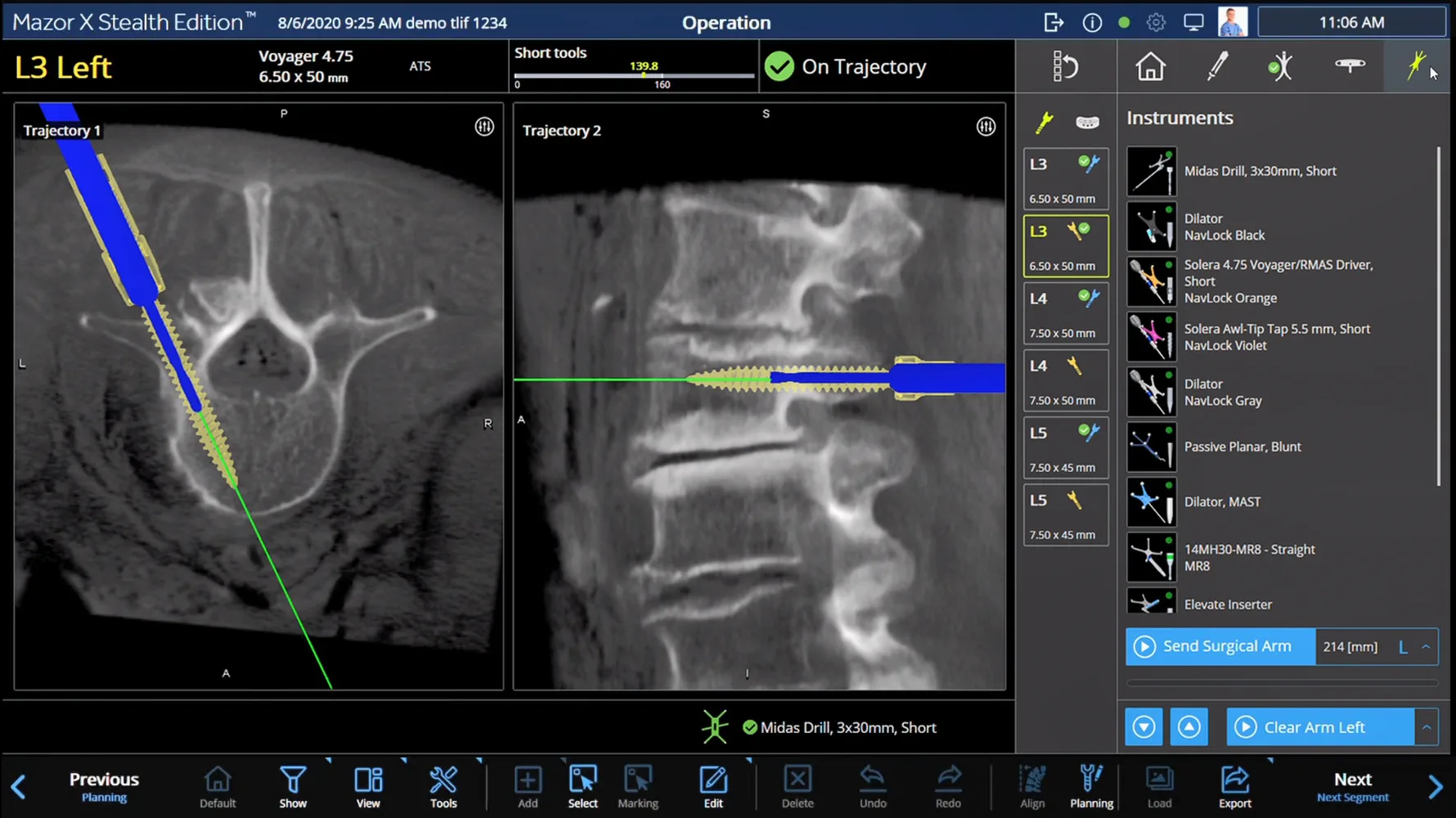 The Medtronic Mazor navigation screen during surgery, showing the drill on its planned path into the L3 vertebra on two views of the CT scan