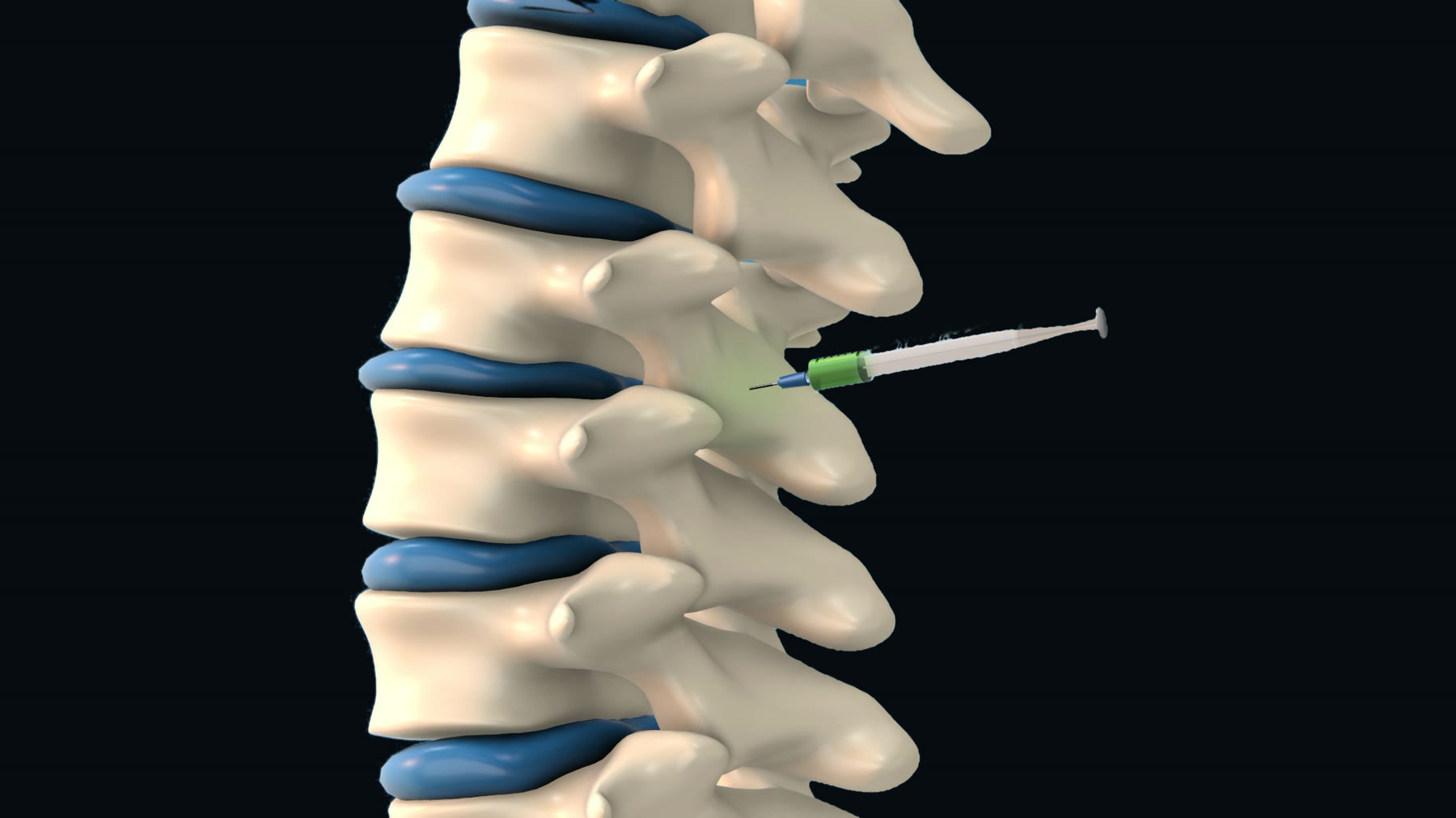 The lower spine from the side, with a needle guided to the joint at the back of one level